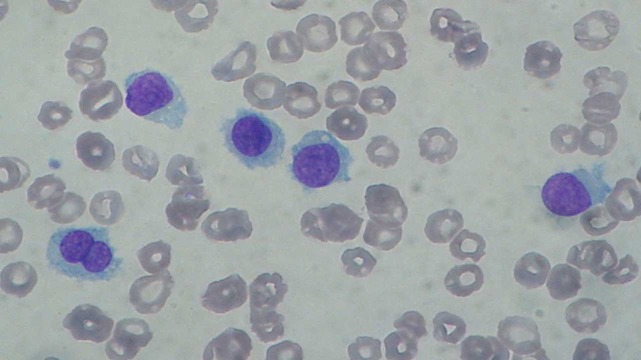 Hairy Cell Leukemia (HCL) | My Hematology