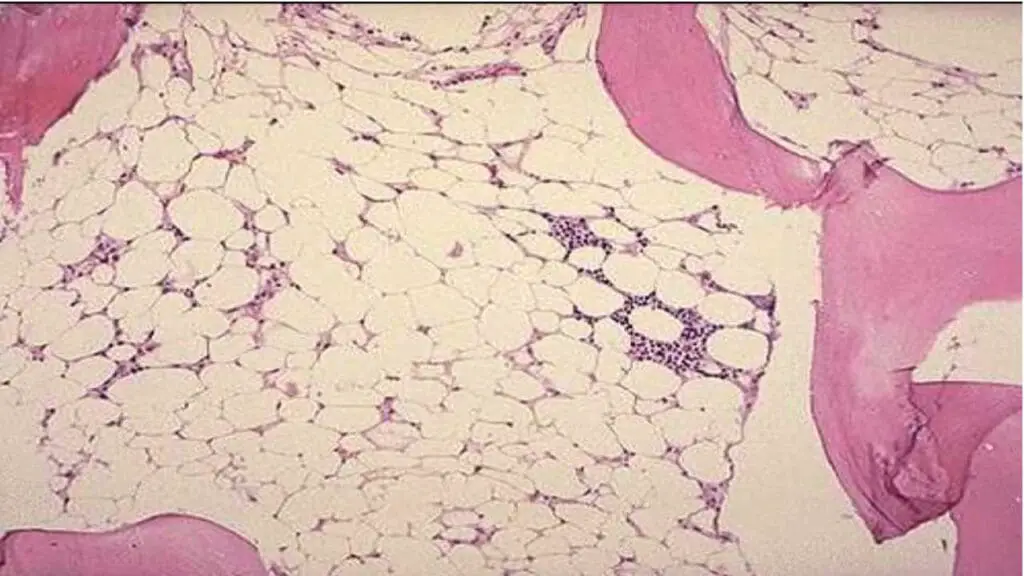 Hypocellular bone marrow in aplastic anemia