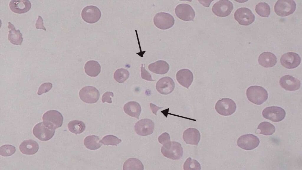 A photomicrograph of a peripheral blood smear with schistocytes (black arrow), polychromatic cells and spherocytes which are  hallmarks of microangiopathic hemolytic anemia as seen in hemolytic uremic syndrome (HUS). 