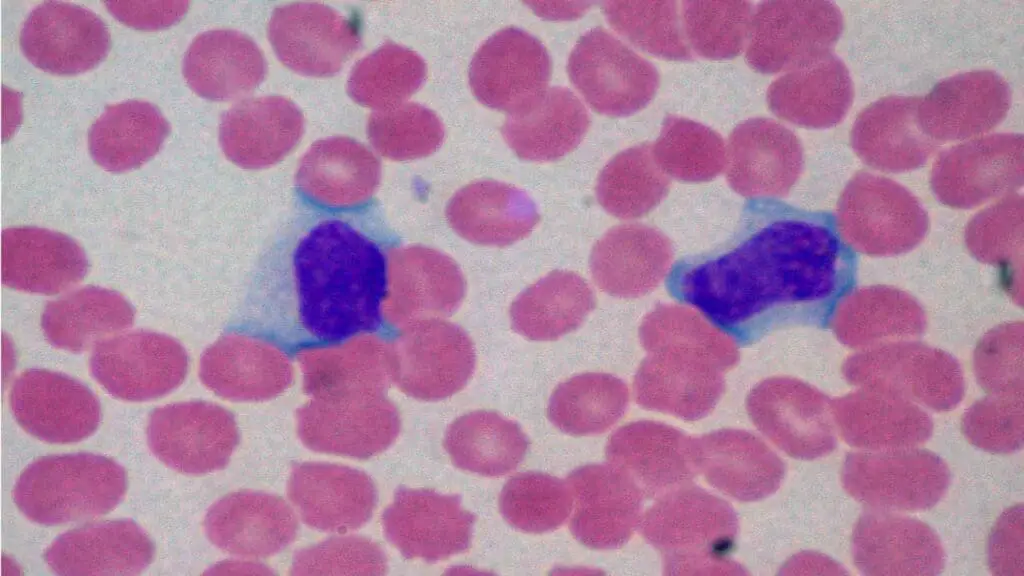 Atypical Lymphocytes (reactive lymphocytes) on high power view of peripheral smear in infectious mononucleosis. 
