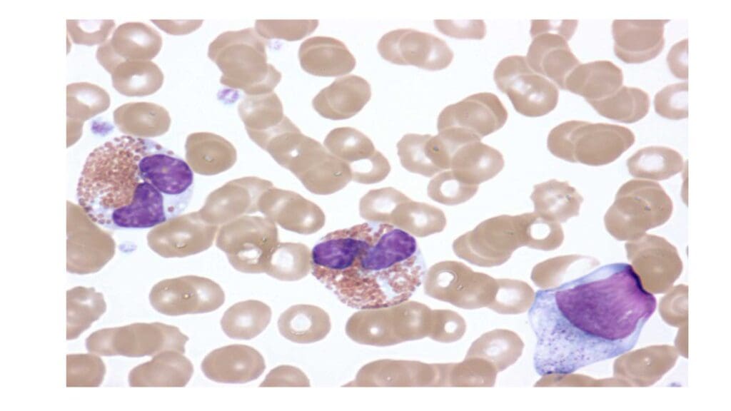 Microscopic examination (100x) of a blood smear from a patient with idiopathic hypereosinophilic syndrome or HES shows activated eosinophils with signs of cellular abnormality, including clear cytoplasm, dysfunctional nuclei, and immature cells.