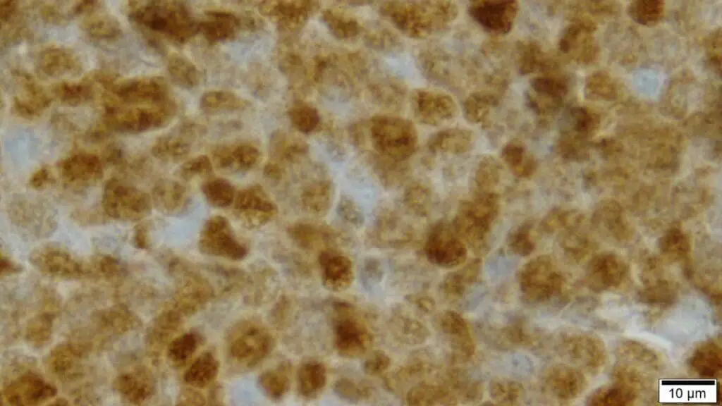 Immunohistochemistry (IHC) staining showed strong nuclear expression of cyclin D1 in the lymphoma cells.