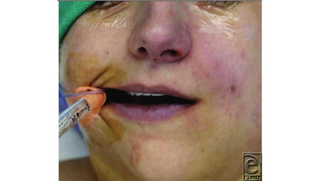 Cyanosis from methemoglobinemia is seen in the bluish-colored lips.