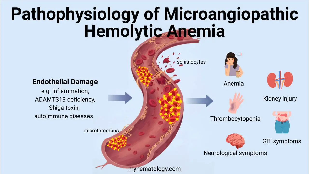 The pathophysiology of Microangiopathic Hemolytic Anemia (MAHA) begins with some form of widespread damage to the endothelium, the inner lining of small blood vessels like capillaries and arterioles. This endothelial injury triggers the formation of small, platelet-rich clots known as microthrombi within the microvasculature. As red blood cells are forced to navigate these partially or completely occluded vessels, they are subjected to immense physical shearing forces, which mechanically fragment them.  This process leads to the formation of schistocytes, the characteristic fragmented red blood cells seen on a blood smear. Concurrently, the continuous formation of these microthrombi consumes the body's circulating platelets, resulting in the associated thrombocytopenia that completes the classical triad of the syndrome.