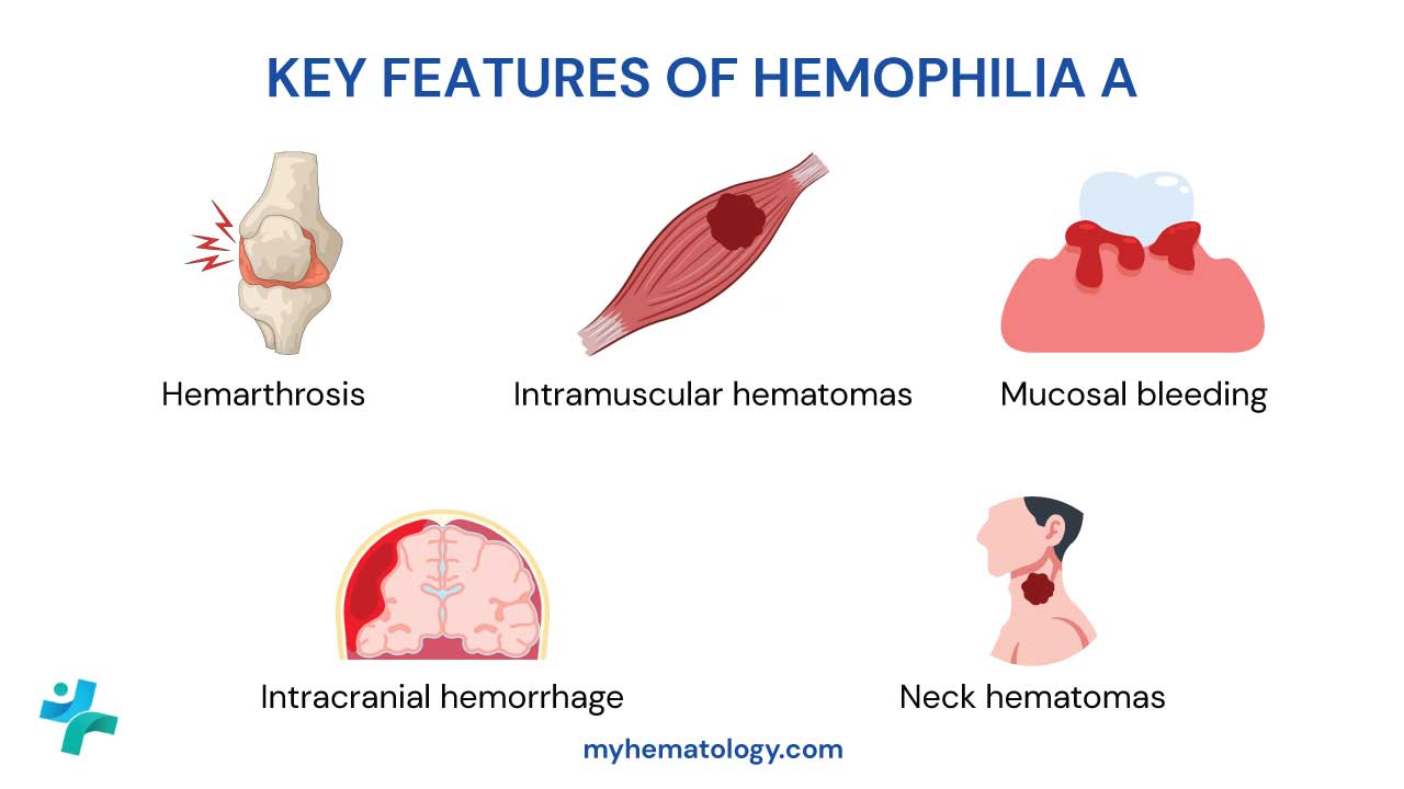 The clinical hallmark of Hemophilia A, particularly in its moderate to severe forms, is deep, spontaneous bleeding that occurs hours or days after the initiating trauma. The most frequent and destructive manifestation is hemarthrosis (bleeding into joints), primarily affecting the knees, elbows, and ankles, which, if recurrent and untreated, leads to hemophilic arthropathy and chronic disability. Other common sites include intramuscular hematomas, which can cause nerve compression or compartment syndrome. While superficial cuts may clot normally due to intact primary hemostasis, life-threatening hemorrhages such as intracranial hemorrhage (the leading cause of death) and oropharyngeal hematomas that risk airway compromise require immediate and aggressive Factor VIII replacement therapy.